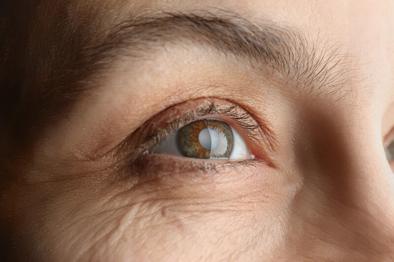 Closeup of a Cataract in an Eye
