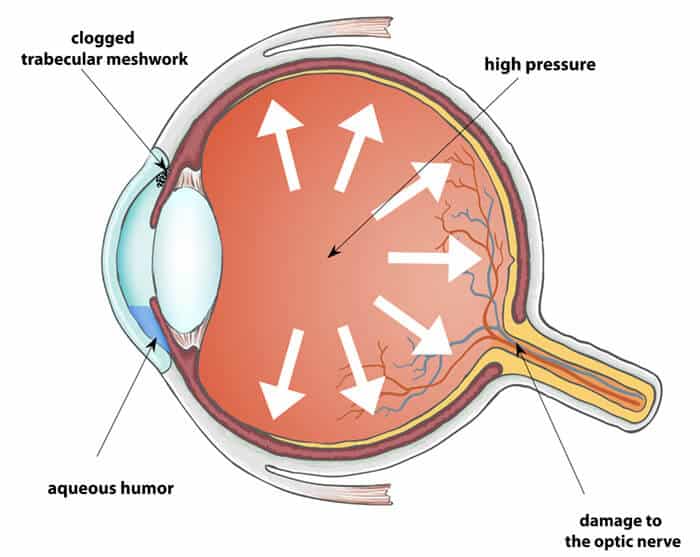 Chart Illustrating how glaucoma affects an eye