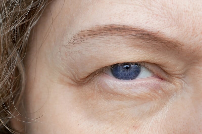 Closeup of someone with ptosis