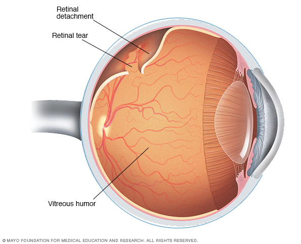 Retinal Detachment Surgery Chart